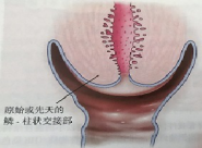 宮頸癌篩查沒(méi)那么簡(jiǎn)單，這些技巧助你提高取樣質(zhì)量